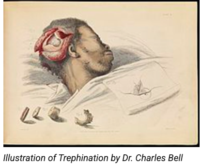 Surgical trephining